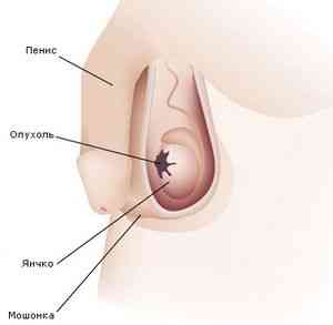 Рак яичек у мужчин симптомы диагностика и лечение | Рак - лечение ...