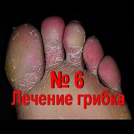 Лечение грибка на ногах народными средствами 6. Молочай-дурнишник (2016) WEBRip