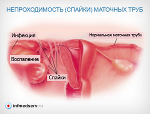 Непроходимость маточных труб: симптомы и лечение